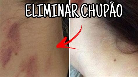 Como tirar chupão: 8 truques simples para remover。